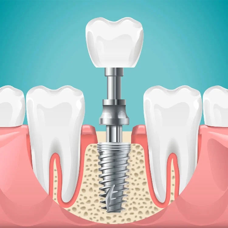 Dental Implants Treatment